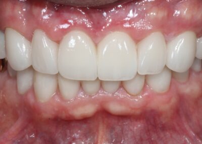 Full Mouth Reconstruction After Smile